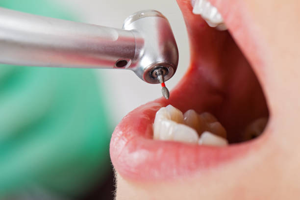 Best Emergency Dentist for Lost Fillings or Crowns in St Helena, CA